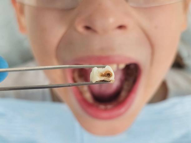 Best Emergency Root Canal Treatment in Maple Park, IL